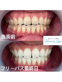 ホワイトニングサロン 熊本店/お得なセルフホワイトニング
