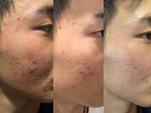 ヨハク(YOHAKU)/ハーブピーリング