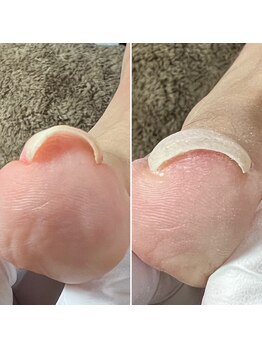 ルーチェ バイ フェリシア(LUCE by Felicia)/【巻き爪ケア】左施術前右半年後