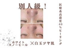 エステティック レイビス 池袋店(RAYVIS)/白玉スノーピール