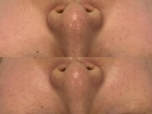 ベアール(beal)/毛穴洗浄×ハーブピーリング2回