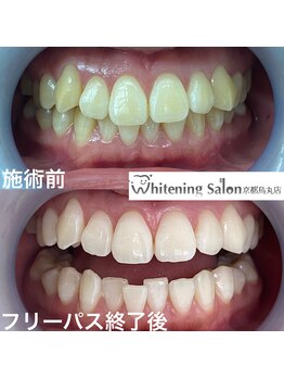 ホワイトニングサロン 京都烏丸店/ホワイトニング施術例