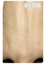 ピリナ 名古屋/【背中ハーブピーリング】症例