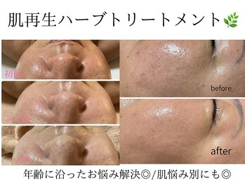 グロウ バイ フェイシャルデザイン アンド アイ(GROW)/肌質改善