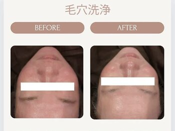 美々庵/ハイドラ 毛穴洗浄