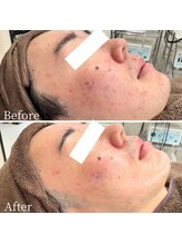 ニキビケア研究所 所沢店/これからできるニキビケアにも◎