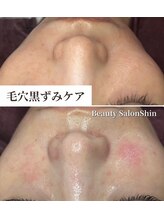 シン(Shin)/【小鼻黒ずみケア】