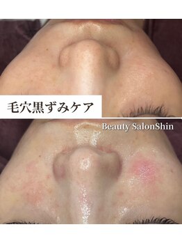 シン(Shin)/【小鼻黒ずみケア】