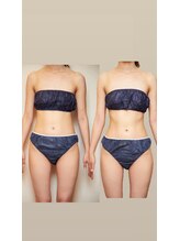 ヨロン(YORON)/キャビＥＭＳ超音波ハンド痩身