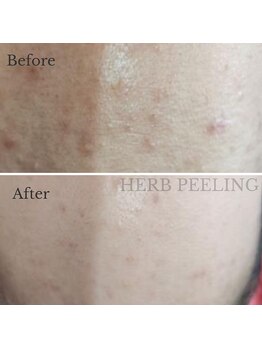 シンディー(CINDY)/手強いニキビにハーブピーリング