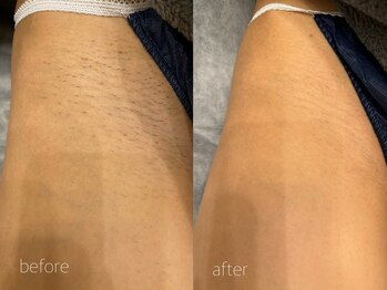 オンセ(once)/VIO脱毛/足脱毛/全身脱毛