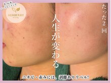 ハーバリー 天王寺(HERBERRY)/ハーブピーリング専門店HERBERRY