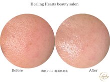 ヒーリングハーツ(Healing Hearts)/陶肌ピール後の肌変化♪