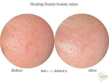 ヒーリングハーツ(Healing Hearts)/陶肌ピール後の肌変化♪