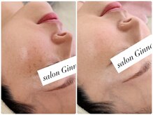 ジーナ(Ginna)の雰囲気（【肌に負担をかけない】数日後には垢となったメラニンがポロリ！）