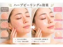 ボヌールウメダ(Bonheur UMEDA)の雰囲気（プロによる肌ケアでニキビ・毛穴・たるみの悩みを改善！）