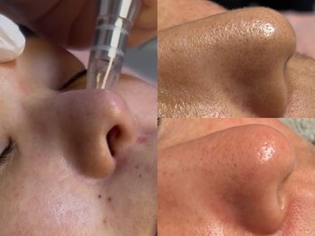 リコ(Ricco)の写真/【Ricco式肌を育てる毛穴洗浄★】黒ずみ・いちご鼻・開き毛穴をその場しのぎではなく肌質から改善★