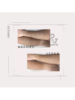 エステモ 札幌店(ESTEMO)/両腕WAX Before&After