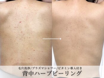 フェイシャルヴィム(FACIAL VIM)の写真/【驚異の殺菌力！背中美人ニキビケア】魅せる背中★ハーブピーリングで肌質改善・ツヤ肌へ