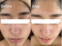 マスカレード 品川(Masquerade)/【症例写真】施術1回