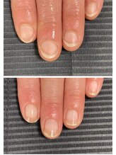 ルカロンネイル(Rukaron Nail)/丸爪＋深爪