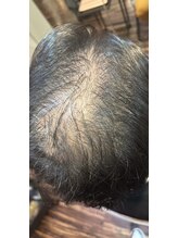 ボニータ(Bonita)/(ヘッド)ヒト羊膜幹細胞エステ