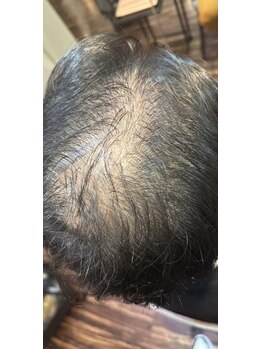 ボニータ(Bonita)/(ヘッド)ヒト羊膜幹細胞エステ