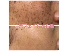 ソライロの雰囲気（光フェイシャルのビフォーアフターです♪　）