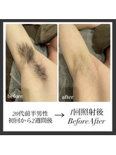 エリクサー 熊谷店(Elixir)/20代前半1回照射