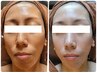 人気急上昇中★【40代からの別人級の透明感】くすみ改善×艶肌リフトケア!