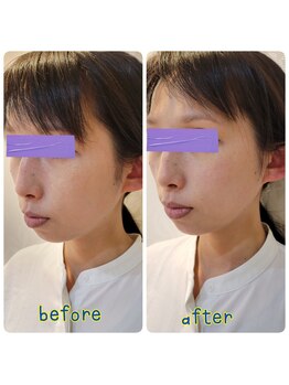 ピエール ナリタイラボ(Piel NARITAI LABO)/小顔整体