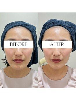 ラ クレール ビューティーサロン(LA CLAIR)/次世代リフトサーマリフトRF管理