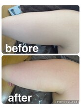 ギンザアール(GINZA R.)/二の腕にアプローチ！