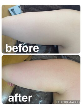 ギンザアール(GINZA R.)/二の腕にアプローチ！