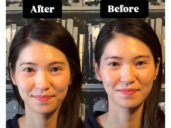 松山鍼灸マッサージ院/初回お試し美容鍼