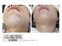 レア(Le'a)/【ひげ脱毛】