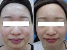 エピア 半田店(Epia)/ニキビケア・赤みニキビケア