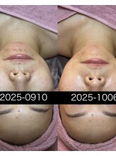 リボーン(Reborn)&nbsp;肌質改善 