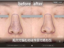 ダイヤモンドトゥルース(Diamond truth)の雰囲気（気になる毛穴も多種多様なフェイシャルで驚く仕上がりに。）
