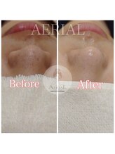 エアリアル 武雄店/毛穴エクストラクション