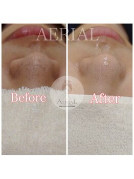 エアリアル 武雄店/毛穴エクストラクション