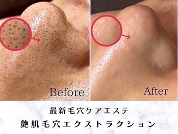 リモア(REMORE.)/艶肌毛穴エクストラクション B/A