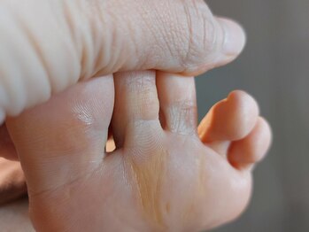 爪切り屋 足楽/胼胝◆第２趾　基節骨