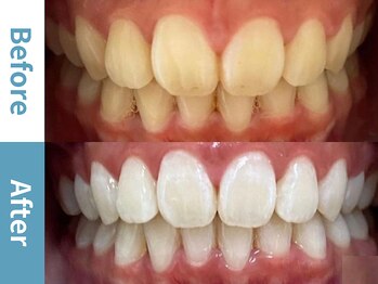 アース 岡崎店(EARTH)/【ビフォーアフター】美白