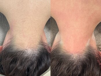 ヒーリングハーツ(Healing Hearts)/うなじ・首周りのシュガーリング