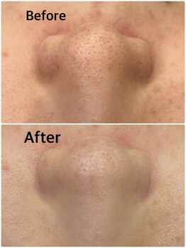 アシュレ リル 西多賀店(assure Lilou)/人気のハイドラピーリング☆