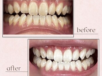 ルアナシンフォニア エクシア 池袋店(Luana-Sinfonia)/ホワイトニングビフォーアフター