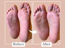 ベベ(Bebe)/40代女性/小指下タコお悩み