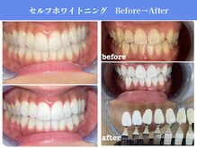 エクシアホワイトニング 岡崎店/セルフホワイトニングNo.1の実績