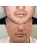 男性人気No1【ヒゲ脱毛×毛穴改善】青ヒゲ・ニキビ対策に/越谷メンズ脱毛
